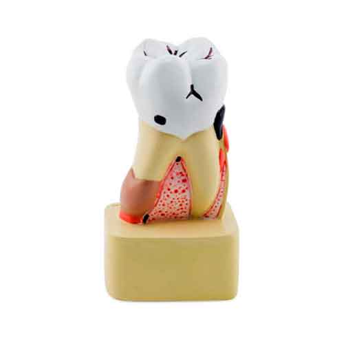 Cargue la imagen en el visor de la galería, Modelo de Enfermedad Dental, 4X Ampliado [SKU: MG22728]
