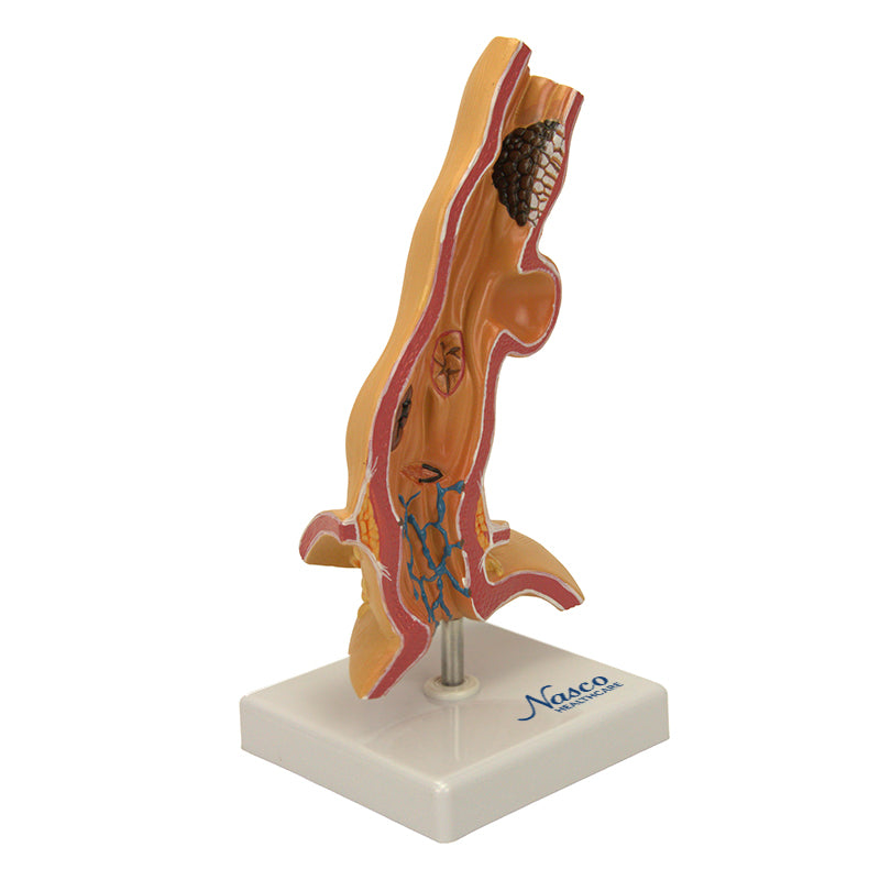 गैलरी व्यूअर में छवि लोड करें, अन्नप्रणाली रोग मॉडल, 5X बढ़ा हुआ [SKU: MG22729]
