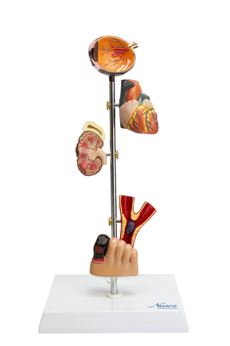 ผลกระทบของโมเดลเบาหวาน, 5 ส่วน [SKU: MG22746]