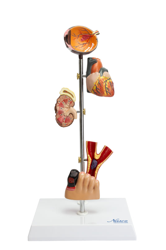 ผลกระทบของโมเดลเบาหวาน, 5 ส่วน [SKU: MG22746]