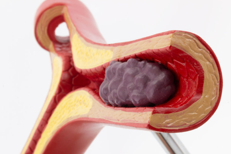 Muat gambar ke penampil Galeri, Arteriosklerosis &amp; Trombus dengan Model Penampang Arteri [SKU: MG29729]
