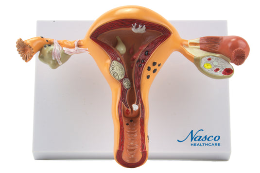 Pathological Uterus Ovary Anatomical Model - Cross-Section Study Tool For Medical Education