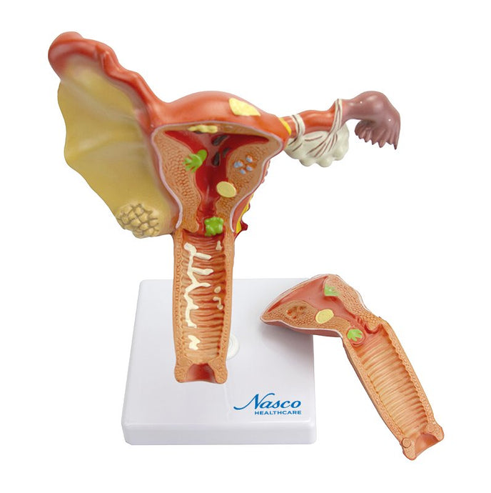 Female Genital Organ with Pathology Model, 2 Parts