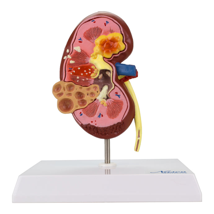Kidney with Pathology Model, 2-1/2X Enlarged