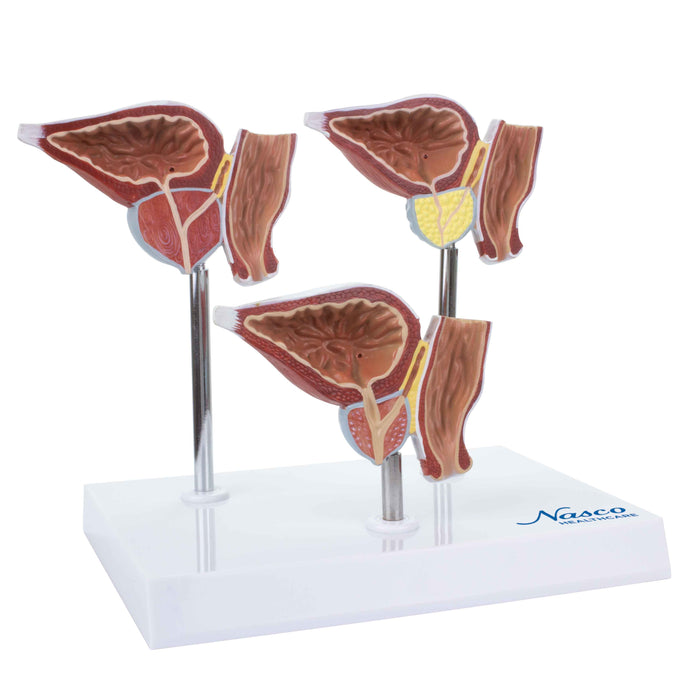 Normale und pathologische Prostatamodelle, 3 Teile [SKU: MG31153]