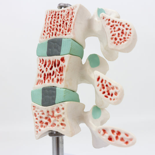 Model Osteoporosis Deluxe, 3 Bagian [SKU: MG32226]