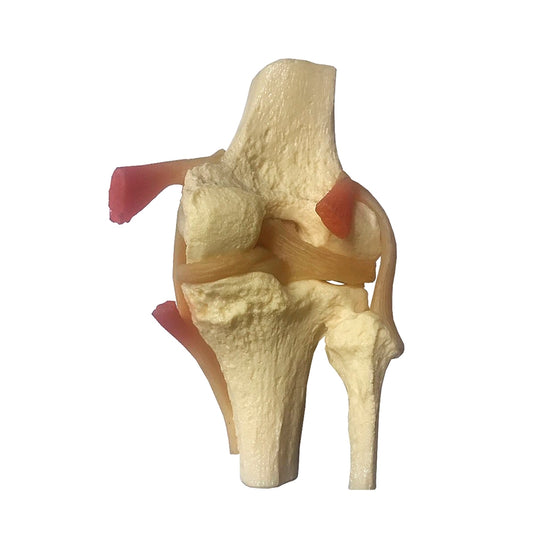 Meniscus Knee with 6 Tears Model
