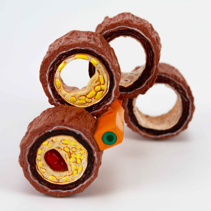 Load image into Gallery viewer, Arteriosclerosis Model, 4 Stages
