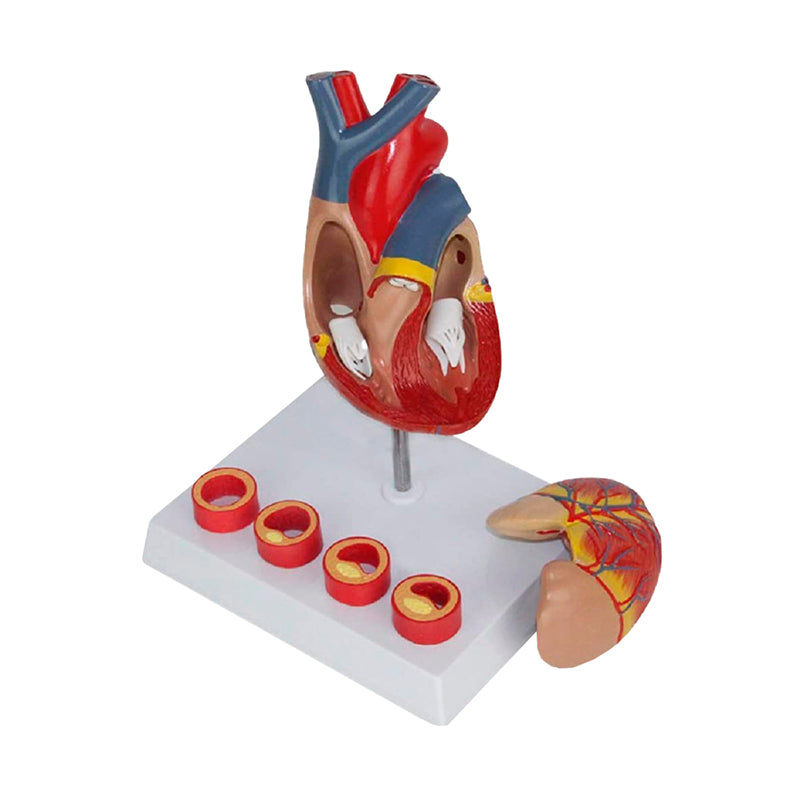 Load image into Gallery viewer, Heart with Arteriosclerosis Model
