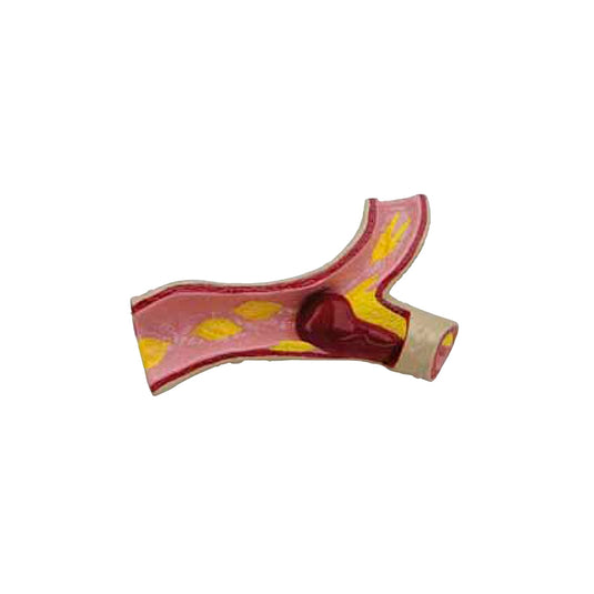 Effects of Type II Diabetes Model