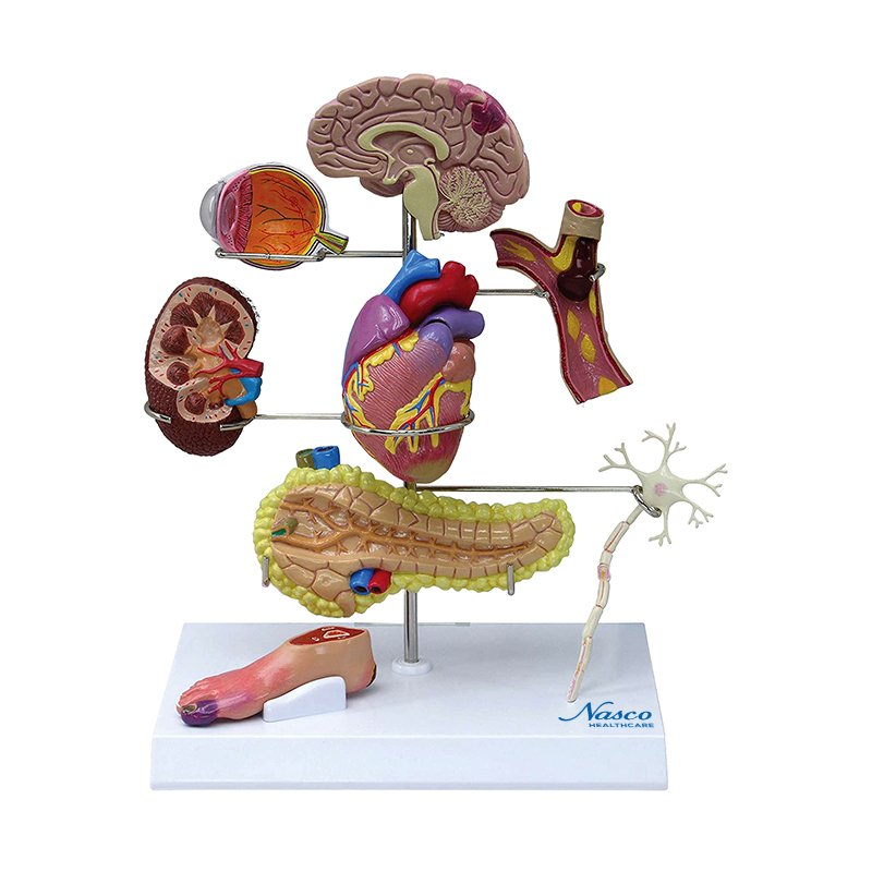 Load image into Gallery viewer, Effects of Type II Diabetes Model
