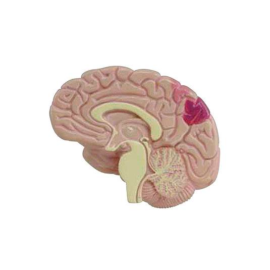 Effects of Type II Diabetes Model
