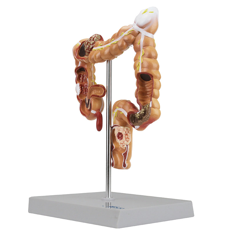 Load image into Gallery viewer, Intestinal Pathologies of Colon &amp; Rectum Model
