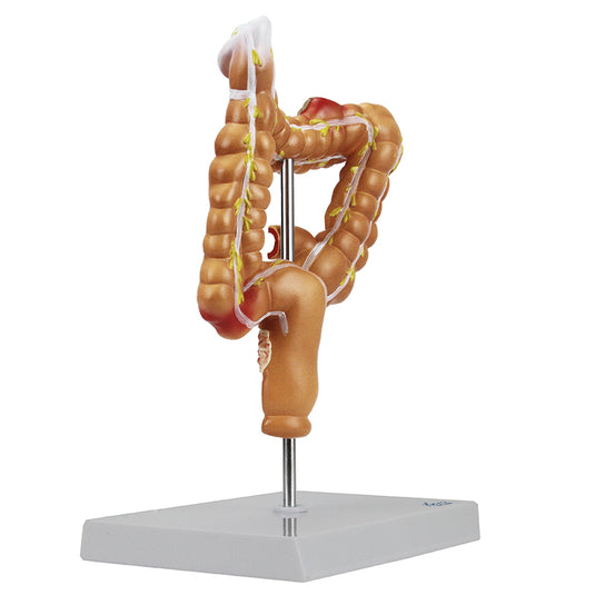 Intestinal Pathologies of Colon & Rectum Model