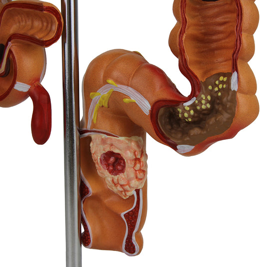 Intestinal Pathologies of Colon & Rectum Model