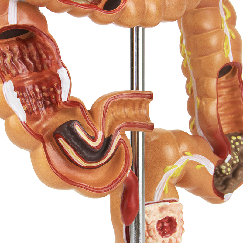 Load image into Gallery viewer, Intestinal Pathologies of Colon &amp; Rectum Model
