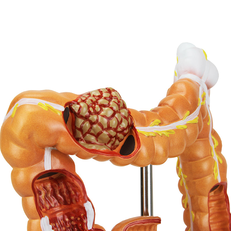 Load image into Gallery viewer, Intestinal Pathologies of Colon &amp; Rectum Model

