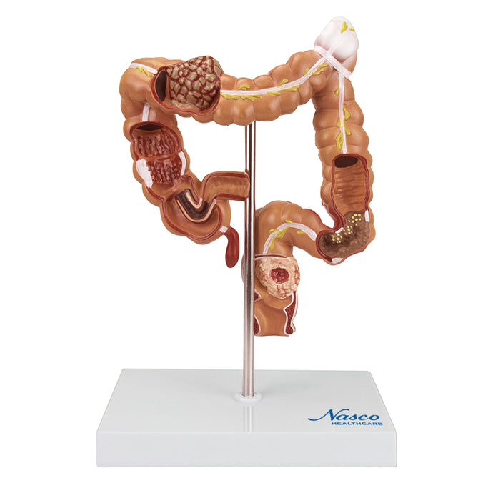 Intestinal Pathologies of Colon & Rectum Model