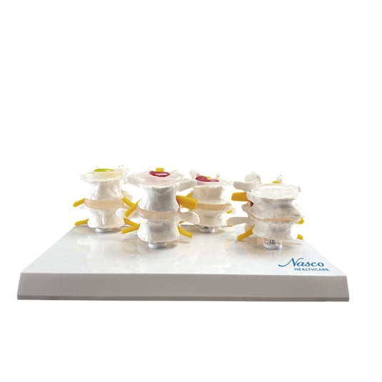Modelo ng Lumbar Vertebrae, 4 Yugto [SKU: MG36171]