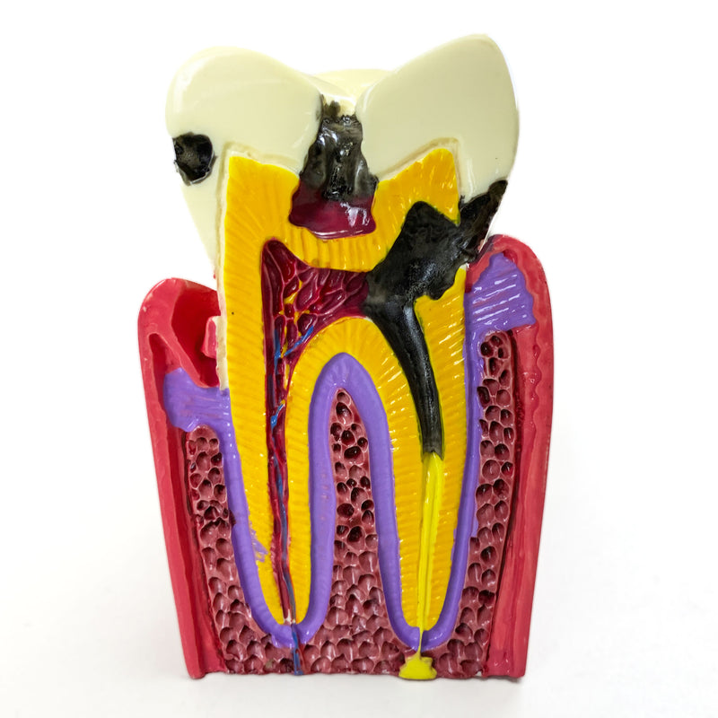 Cargue la imagen en el visor de la galería, Modelo de Enfermedad Dental, 6X Ampliado [SKU: MG39442]
