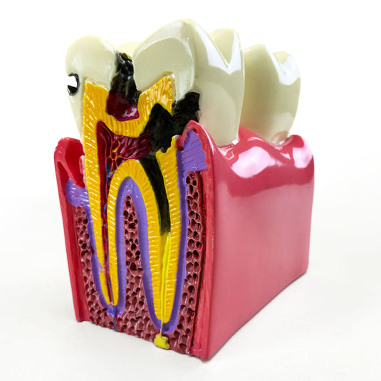 Modelo de Enfermedad Dental, 6X Ampliado [SKU: MG39442]