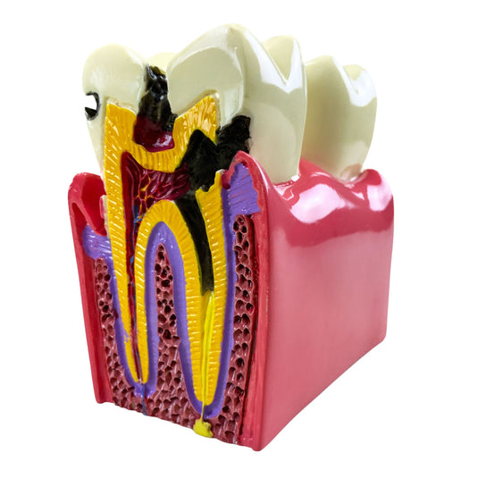 Modelo de Enfermedad Dental, 6X Ampliado [SKU: MG39442]