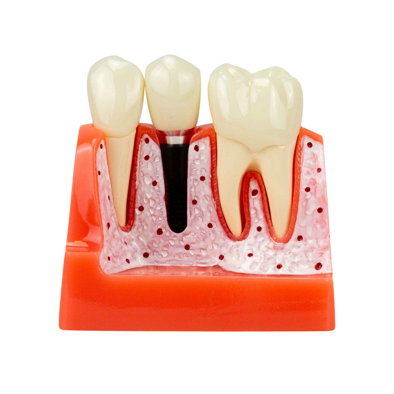 Cargue la imagen en el visor de la galería, Modelo de Implante Dental, 8 Piezas [SKU: MG39444]
