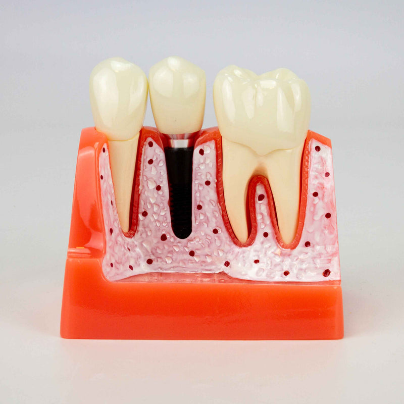 Cargue la imagen en el visor de la galería, Modelo de Implante Dental, 8 Piezas [SKU: MG39444]
