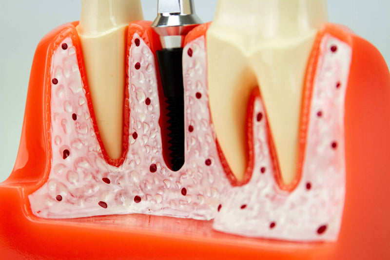 Cargue la imagen en el visor de la galería, Modelo de Implante Dental, 8 Piezas [SKU: MG39444]
