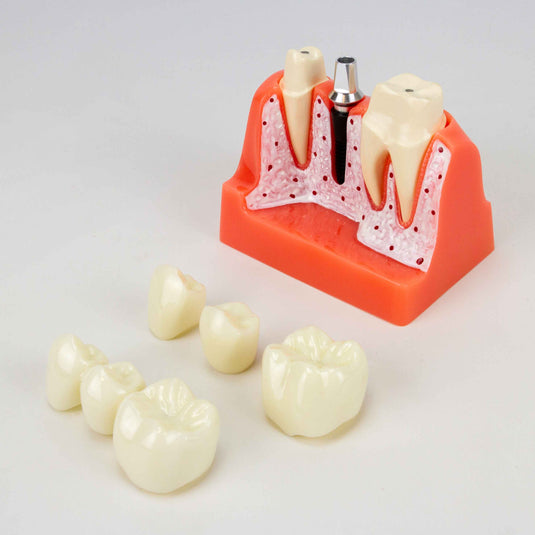 Modelo de Implante Dental, 8 Piezas [SKU: MG39444]