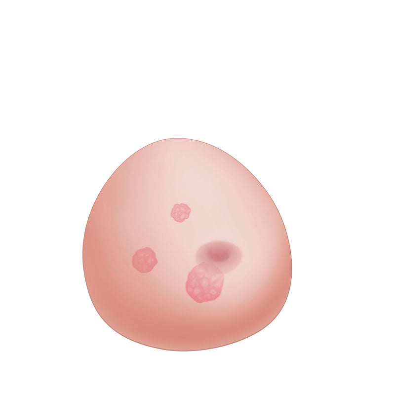 Load image into Gallery viewer, SONOtrain Breast Model with Tumors [SKU: 109635]
