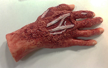 Chemical Burn, 4Th Degree, Right Hand