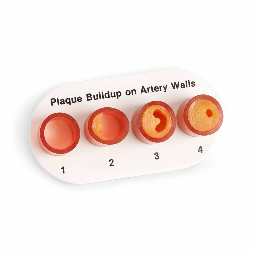 Artery Sections with Blockage [SKU: WA09742]