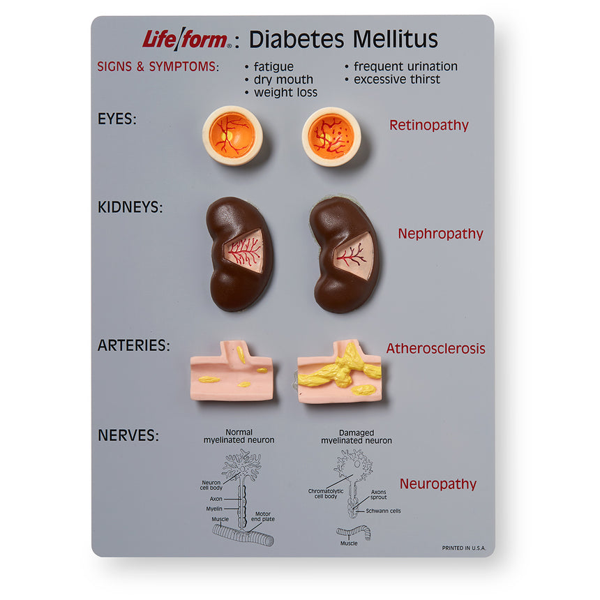 Life/form® Diabetes Mellitus Teaching Kit [SKU: WA20495]